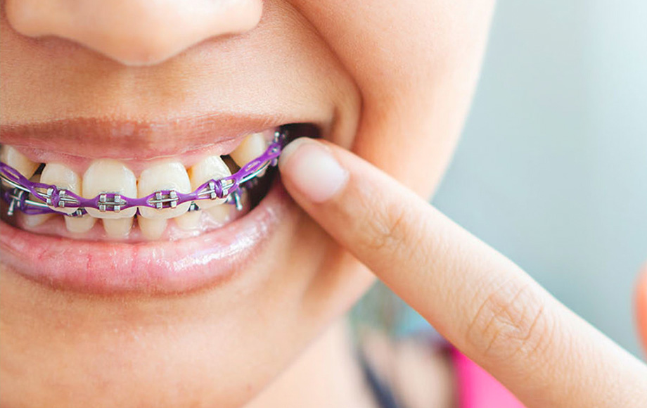 img-ortho-life-with-braces-02