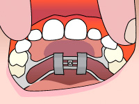 thumb-ortho-palatal-01