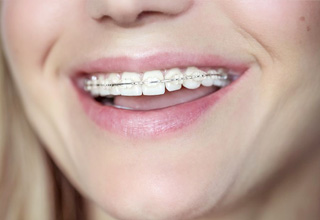 thumb-treatment-types-ceramic